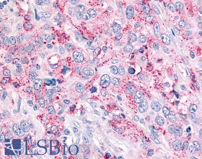 USP4 Antibody - Anti-USP4 / UNP antibody IHC of human Lung, Non-Small Cell Carcinoma. Immunohistochemistry of formalin-fixed, paraffin-embedded tissue after heat-induced antigen retrieval.