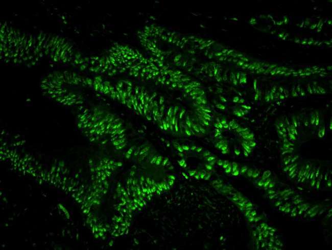 USP7 / HAUSP Antibody - Detection of Human USP7 by Immunofluorescence. Sample: FFPE section of human colon adenocarcinoma. Antibody: Affinity purified rabbit anti-USP7 used at a dilution of 1:100. Detection: Green-fluorescent Anti-rabbit IgG-FITC conjugated used at a dilution of 1:100.