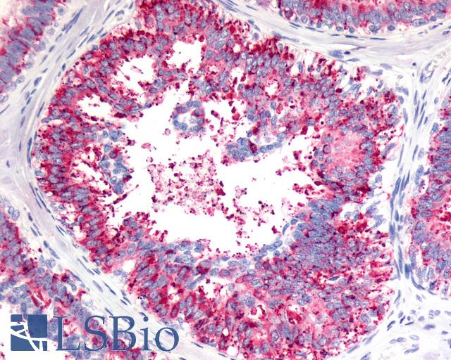V1RL1 / VN1R1 Antibody - Anti-V1RL1 / VN1R1 antibody IHC of human Breast, Carcinoma. Immunohistochemistry of formalin-fixed, paraffin-embedded tissue after heat-induced antigen retrieval.