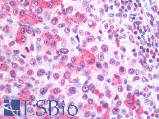 WNT10A Antibody - Human Melanoma (Lymph Node): Formalin-Fixed, Paraffin-Embedded (FFPE)
