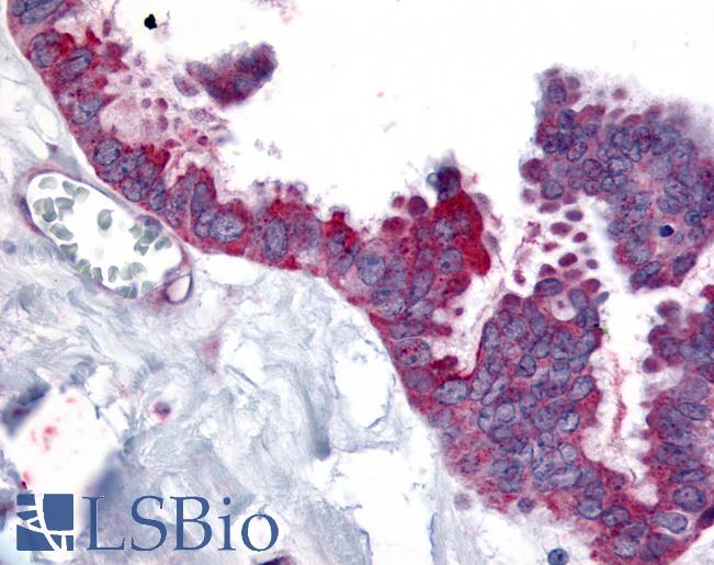 WNT2B Antibody - Anti-WNT2B antibody IHC of human Ovary, Carcinoma. Immunohistochemistry of formalin-fixed, paraffin-embedded tissue after heat-induced antigen retrieval.