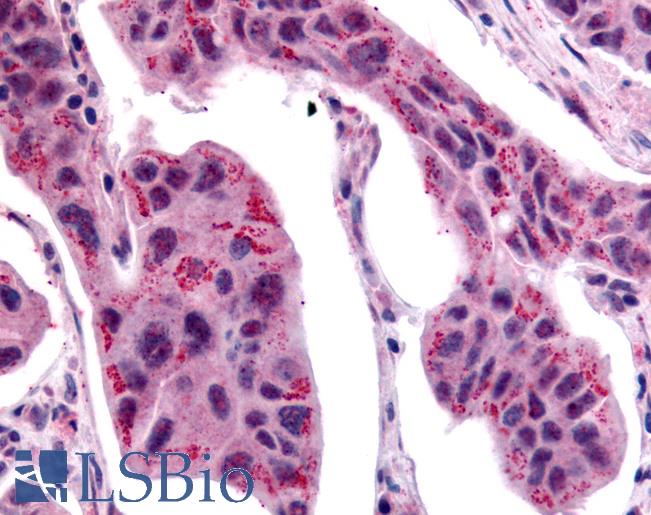 WNT2B Antibody - Anti-WNT2B antibody IHC of human Breast, Carcinoma. Immunohistochemistry of formalin-fixed, paraffin-embedded tissue after heat-induced antigen retrieval.