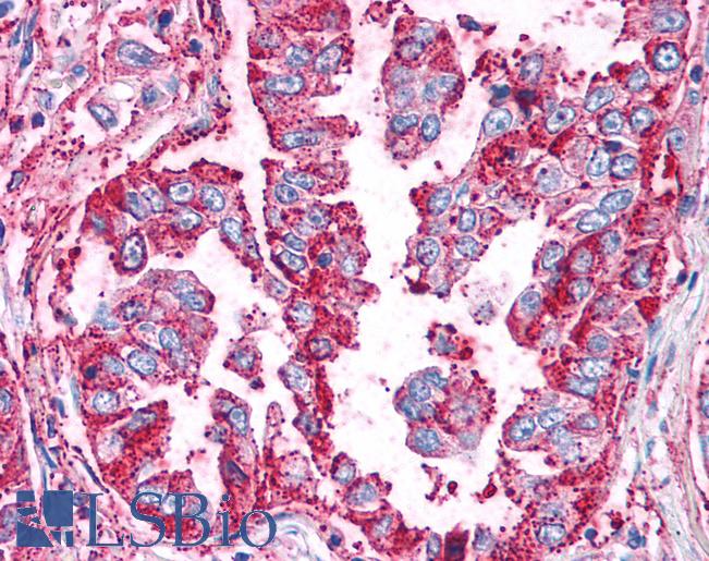 WNT5B Antibody - Anti-WNT5B antibody IHC of human Lung, Non-Small Cell Carcinoma. Immunohistochemistry of formalin-fixed, paraffin-embedded tissue after heat-induced antigen retrieval.