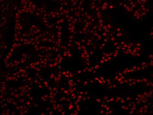 XRN2 Antibody - Detection of Human XRN2 by Immunofluorescence. Sample: FFPE section of human prostate carcinoma. Antibody: Affinity purified rabbit anti-XRN2 used at a dilution of 1:100. Detection: Red-fluorescent goat anti-rabbit IgG highly cross-adsorbed Antibody.