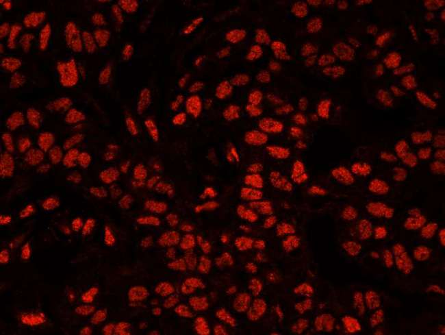 XRN2 Antibody - Detection of Human XRN2 by Immunofluorescence. Sample: FFPE section of human breast carcinoma. Antibody: Affinity purified rabbit anti-XRN2 used at a dilution of 1:100. Detection: Red-fluorescent Alexa Fluor 555 goat anti-rabbit IgG (Invitrogen) used at a dilution of 1:500.