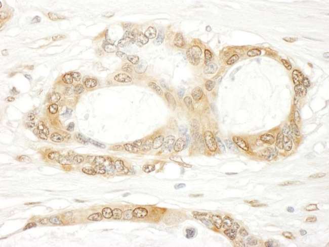 YAP / YAP1 Antibody - Detection of Human YAP1 by Immunohistochemistry. Sample: FFPE section of human ovarian carcinoma. Antibody: Affinity purified rabbit anti-YAP1 used at a dilution of 1:500.