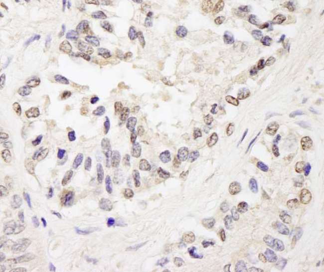 ZFPM1 / FOG1 Antibody - Detection of Human FOG1/ZFPM1 by Immunohistochemistry. Sample: FFPE section of human prostate carcinoma. Antibody: Affinity purified rabbit anti-FOG1/ZFPM1 used at a dilution of 1:200 (1 ug/ml). Detection: DAB.