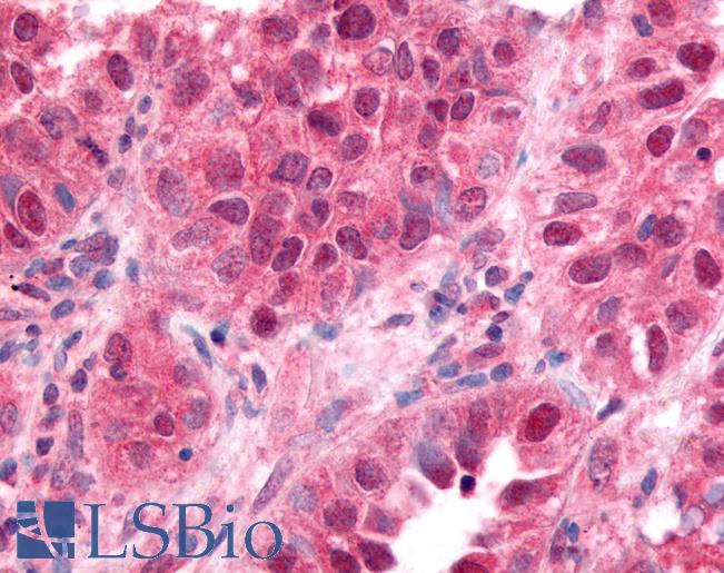 ZIF268 / EGR1 Antibody - Anti-EGR1 antibody IHC of human lung small cell carcinoma. Immunohistochemistry of formalin-fixed, paraffin-embedded tissue after heat-induced antigen retrieval. Antibody concentration 10 ug/ml.
