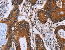 IHH Antibody - Immunohistochemistry of paraffin-embedded Human lung cancer using IHH Polyclonal Antibody at dilution of 1:30.