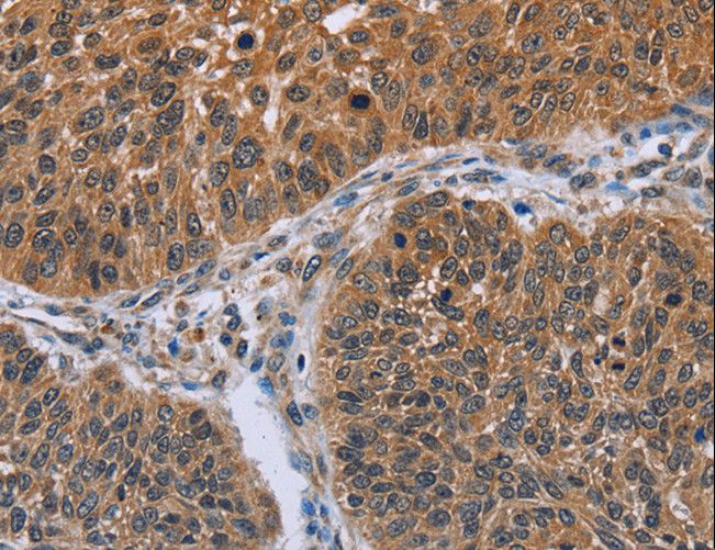 IHH Antibody - Immunohistochemistry of paraffin-embedded Human lung cancer using IHH Polyclonal Antibody at dilution of 1:30.