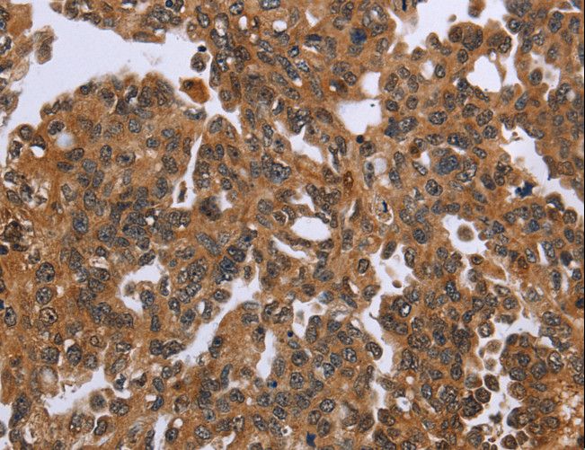 IHH Antibody - Immunohistochemistry of paraffin-embedded Human ovarian cancer using IHH Polyclonal Antibody at dilution of 1:50.