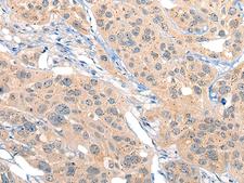 IIP45 / MIIP Antibody - Immunohistochemistry of paraffin-embedded Human esophagus cancer tissue  using MIIP Polyclonal Antibody at dilution of 1:45(×200)