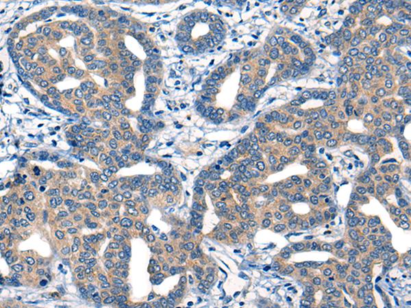 IIP45 / MIIP Antibody - Immunohistochemistry of paraffin-embedded Human liver cancer tissue  using MIIP Polyclonal Antibody at dilution of 1:45(×200)
