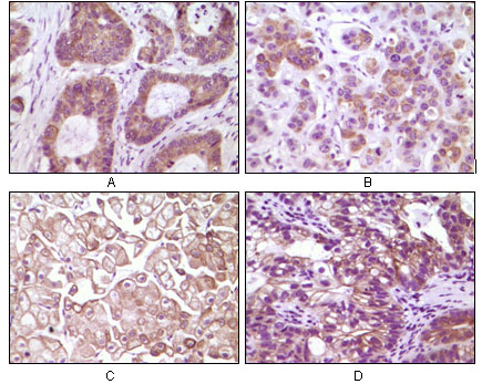IKBIP Antibody - IHC of paraffin-embedded human colon carcinoma(A), breast carcinoma(B), kidney cell carcinoma(C), bladder carcinoma tumor(D), showing membrane and cytoplasmic localization using IKBKB mouse monoclonal antibody with DAB staining.
