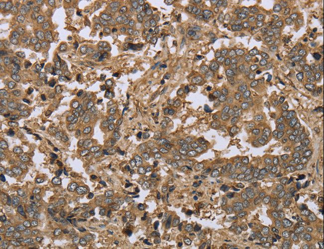 IKBIP Antibody - Immunohistochemistry of paraffin-embedded Human lung cancer using IKBIP Polyclonal Antibody at dilution of 1:30.