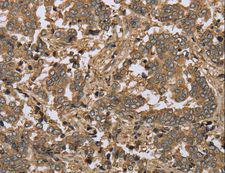 IKBIP Antibody - Immunohistochemistry of paraffin-embedded Human lung cancer using IKBIP Polyclonal Antibody at dilution of 1:30.