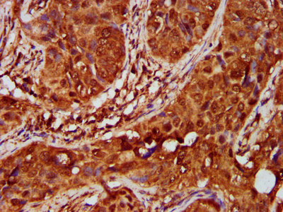 IKBKAP / IKAP Antibody - Immunohistochemistry Dilution at 1:600 and staining in paraffin-embedded human cervical cancer performed on a Leica BondTM system. After dewaxing and hydration, antigen retrieval was mediated by high pressure in a citrate buffer (pH 6.0). Section was blocked with 10% normal Goat serum 30min at RT. Then primary antibody (1% BSA) was incubated at 4°C overnight. The primary is detected by a biotinylated Secondary antibody and visualized using an HRP conjugated SP system.