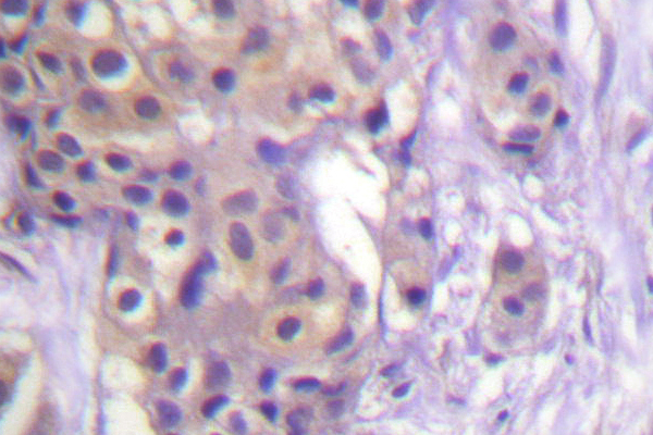 IKBKB / IKK2 / IKK Beta Antibody - IHC of IKK- (L193) pAb in paraffin-embedded human breast carcinoma tissue.