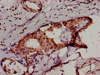 IKBKB / IKK2 / IKK Beta Antibody - IHC image of IKBKB Antibody diluted at 1:500 and staining in paraffin-embedded human breast cancer performed on a Leica BondTM system. After dewaxing and hydration, antigen retrieval was mediated by high pressure in a citrate buffer (pH 6.0). Section was blocked with 10% normal goat serum 30min at RT. Then primary antibody (1% BSA) was incubated at 4°C overnight. The primary is detected by a biotinylated secondary antibody and visualized using an HRP conjugated SP system.