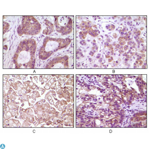 IKBKB / IKK2 / IKK Beta Antibody - Immunohistochemistry (IHC) analysis of paraffin-embedded Human Colon carcinoma(A), breast carcinoma(B), kidney cell carcinoma(C), bladder carcinoma tumor(D), showing membrane and cytoplasmic localization with DAB staining using IKKbeta Monoclonal Antibody.