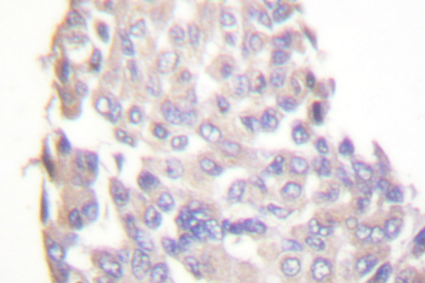 IKBKB / IKK2 / IKK Beta Antibody - IHC of IKK- (F182) pAb in paraffin-embedded human breast carcinoma tissue.