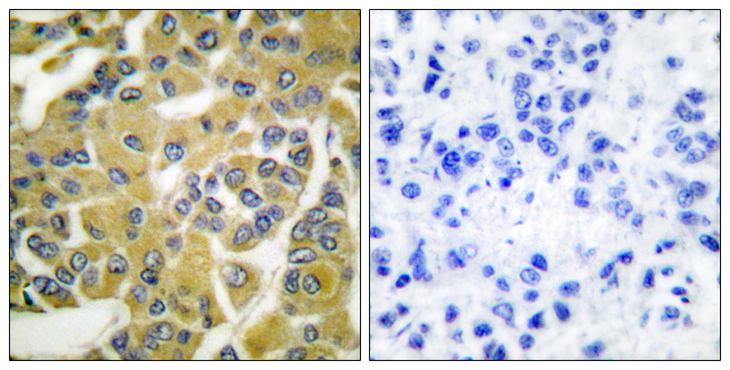 IKBKB / IKK2 / IKK Beta Antibody - Immunohistochemistry analysis of paraffin-embedded human breast carcinoma, using IKK-beta (Phospho-Tyr188) Antibody. The picture on the right is blocked with the phospho peptide.