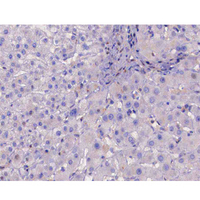 IKBKB / IKK2 / IKK Beta Antibody - 1:200 staining human liver carcinoma tissues by IHC-P. The tissue was formaldehyde fixed and a heat mediated antigen retrieval step in citrate buffer was performed. The tissue was then blocked and incubated with the antibody for 1.5 hours at 22°C. An HRP conjugated goat anti-rabbit antibody was used as the secondary.