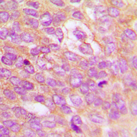 IKBKB / IKK2 / IKK Beta Antibody - Immunohistochemical analysis of IKK beta (pY199) staining in human breast cancer formalin fixed paraffin embedded tissue section. The section was pre-treated using heat mediated antigen retrieval with sodium citrate buffer (pH 6.0). The section was then incubated with the antibody at room temperature and detected using an HRP conjugated compact polymer system. DAB was used as the chromogen. The section was then counterstained with hematoxylin and mounted with DPX.