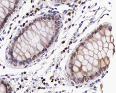IKBKB / IKK2 / IKK Beta Antibody - 1:200 staining human colon carcinoma tissue by IHC-P. The tissue was formaldehyde fixed and a heat mediated antigen retrieval step in citrate buffer was performed. The tissue was then blocked and incubated with the antibody for 1.5 hours at 22°C. An HRP conjugated goat anti-rabbit antibody was used as the secondary.