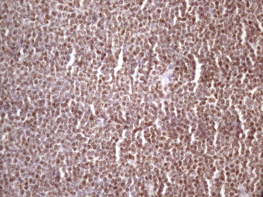 IKBKE / IKKI / IKKE Antibody - Immunohistochemical staining of paraffin-embedded Human lymphoma tissue using anti-IKBKE mouse monoclonal antibody. (Heat-induced epitope retrieval by 1 mM EDTA in 10mM Tris, pH8.5, 120C for 3min. (1:150)
