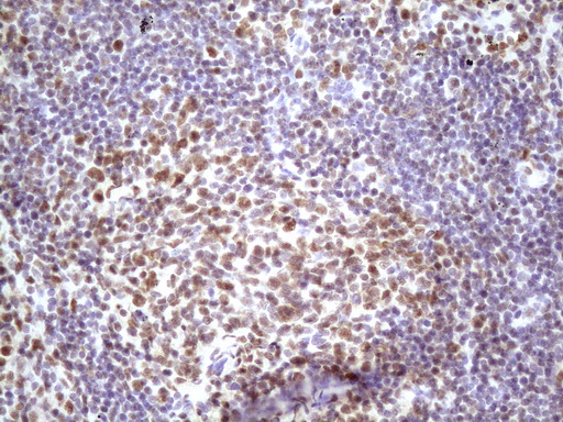 IKBKE / IKKI / IKKE Antibody - IHC of paraffin-embedded Carcinoma of Human lung tissue using anti-IKBKE mouse monoclonal antibody. (Heat-induced epitope retrieval by 1 mM EDTA in 10mM Tris, pH8.5, 120°C for 3min)(1:150).