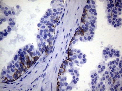 IKBKE / IKKI / IKKE Antibody - Immunohistochemical staining of paraffin-embedded Carcinoma of Human prostate tissue using anti-IKBKE mouse monoclonal antibody. (Heat-induced epitope retrieval by 1mM EDTA in 10mM Tris buffer. (pH8.5) at 120°C for 3 min. (1:150)
