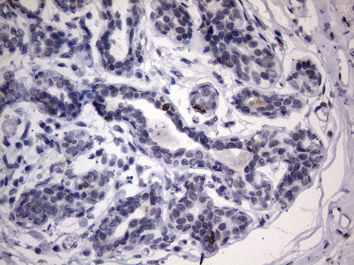 IKBKE / IKKI / IKKE Antibody - Immunohistochemical staining of paraffin-embedded Human breast tissue within the normal limits using anti-IKBKE mouse monoclonal antibody. (Heat-induced epitope retrieval by 1mM EDTA in 10mM Tris buffer. (pH8.5) at 120°C for 3 min. (1:150)