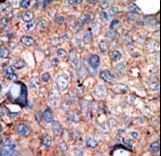IKBKE / IKKI / IKKE Antibody - Formalin-fixed and paraffin-embedded human cancer tissue reacted with the primary antibody, which was peroxidase-conjugated to the secondary antibody, followed by AEC staining. This data demonstrates the use of this antibody for immunohistochemistry; clinical relevance has not been evaluated. BC = breast carcinoma; HC = hepatocarcinoma.