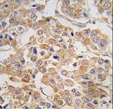 IKBKE / IKKI / IKKE Antibody - Formalin-fixed and paraffin-embedded human breast carcinoma tissue reacted with IKKE Antibody , which was peroxidase-conjugated to the secondary antibody, followed by DAB staining. This data demonstrates the use of this antibody for immunohistochemistry; clinical relevance has not been evaluated.