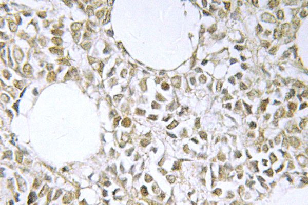 IKBKG / NEMO / IKK Gamma Antibody - IHC of IKK (H81) pAb in paraffin-embedded human breast carcinoma tissue.