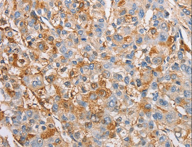 IKBKG / NEMO / IKK Gamma Antibody - Immunohistochemistry of paraffin-embedded Human liver cancer using IKBKG Polyclonal Antibody at dilution of 1:60.