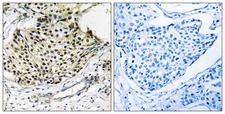 IKBKG / NEMO / IKK Gamma Antibody - Immunohistochemistry analysis of paraffin-embedded human breast carcinoma, using IKK-gamma (Phospho-Ser31) Antibody. The picture on the right is blocked with the phospho peptide.