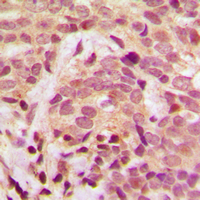 IKBKG / NEMO / IKK Gamma Antibody - Immunohistochemical analysis of IKK gamma (pS31) staining in human breast cancer formalin fixed paraffin embedded tissue section. The section was pre-treated using heat mediated antigen retrieval with sodium citrate buffer (pH 6.0). The section was then incubated with the antibody at room temperature and detected using an HRP conjugated compact polymer system. DAB was used as the chromogen. The section was then counterstained with hematoxylin and mounted with DPX.