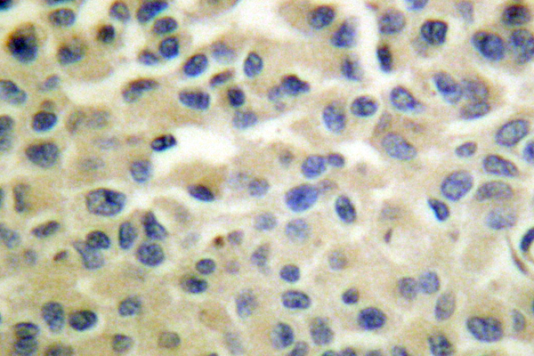 IKK Alpha+Beta Antibody - IHC of IKK/ (Q174) pAb in paraffin-embedded human breast carcinoma tissue.