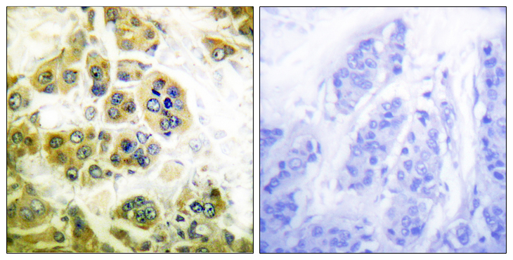 IKK Alpha+Beta Antibody - Immunohistochemistry analysis of paraffin-embedded human breast carcinoma tissue, using IKK-alpha/beta Antibody. The picture on the right is blocked with the synthesized peptide.