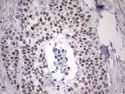 IKZF3 / AIOLOS Antibody - Immunohistochemical staining of paraffin-embedded Carcinoma of Human kidney tissue using anti-IKZF3 mouse monoclonal antibody. (Heat-induced epitope retrieval by 1 mM EDTA in 10mM Tris, pH8.5, 120C for 3min,