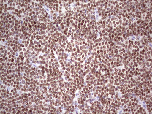 IKZF3 / AIOLOS Antibody - Immunohistochemical staining of paraffin-embedded Human lymphoma tissue using anti-IKZF3 mouse monoclonal antibody. (Heat-induced epitope retrieval by 1 mM EDTA in 10mM Tris, pH8.5, 120C for 3min,