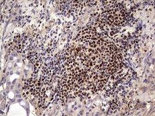 IKZF3 / AIOLOS Antibody - Immunohistochemical staining of paraffin-embedded Carcinoma of Human lung tissue using anti-IKZF3 mouse monoclonal antibody. (Heat-induced epitope retrieval by 1 mM EDTA in 10mM Tris, pH8.5, 120C for 3min,