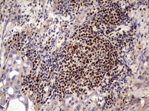 IKZF3 / AIOLOS Antibody - IHC of paraffin-embedded Carcinoma of Human lung tissue using anti-IKZF3 mouse monoclonal antibody. (Heat-induced epitope retrieval by 1 mM EDTA in 10mM Tris, pH8.5, 120°C for 3min).
