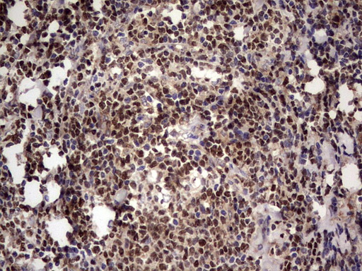IKZF3 / AIOLOS Antibody - IHC of paraffin-embedded Human lymphoma tissue using anti-IKZF3 mouse monoclonal antibody. (Heat-induced epitope retrieval by 1 mM EDTA in 10mM Tris, pH8.5, 120°C for 3min).