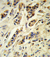 IL-10 Antibody - Formalin-fixed and paraffin-embedded human breast carcinoma reacted with IL10 Antibody , which was peroxidase-conjugated to the secondary antibody, followed by DAB staining. This data demonstrates the use of this antibody for immunohistochemistry; clinical relevance has not been evaluated.