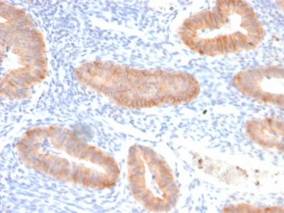 IL-10 Antibody - Formalin-fixed, paraffin-embedded human Endo-cervical Carcinoma stained with Interleukin 10 Recombinant Rabbit Monoclonal Antibody (IL10/2651R).