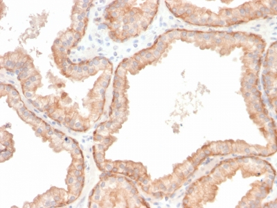 IL-10 Antibody - Formalin-fixed, paraffin-embedded human Prostate Carcinoma stained with Interleukin 10 Recombinant Rabbit Monoclonal Antibody (IL10/2651R).