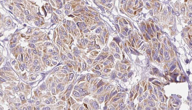 IL-10 Antibody - 1:100 staining human Melanoma tissue by IHC-P. The sample was formaldehyde fixed and a heat mediated antigen retrieval step in citrate buffer was performed. The sample was then blocked and incubated with the antibody for 1.5 hours at 22°C. An HRP conjugated goat anti-rabbit antibody was used as the secondary.